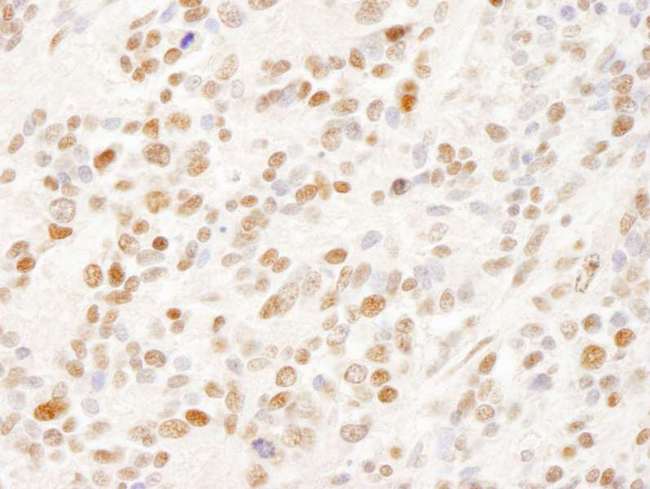 SUGP2 / SFRS14 Antibody - Detection of Human SFRS14 by Immunohistochemistry. Sample: FFPE section of human Ewing sarcoma. Antibody: Affinity purified rabbit anti-SFRS14 used at a dilution of 1:200 (1 ug/ml). Detection: DAB.