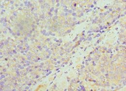 SULT1A1 / Sulfotransferase 1A1 Antibody - Immunohistochemistry of paraffin-embedded human rectal cancer using antibody at 1:100 dilution.