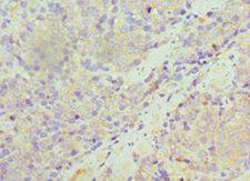 SULT1A1 / Sulfotransferase 1A1 Antibody - Immunohistochemistry of paraffin-embedded human rectal cancer using antibody at 1:100 dilution.