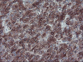 SULT1A1 / Sulfotransferase 1A1 Antibody - IHC of paraffin-embedded Carcinoma of Human liver tissue using anti-SULT1A1 mouse monoclonal antibody.