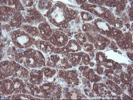 SULT1A1 / Sulfotransferase 1A1 Antibody - IHC of paraffin-embedded Carcinoma of Human thyroid tissue using anti-SULT1A1 mouse monoclonal antibody.