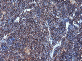 SULT1A1 / Sulfotransferase 1A1 Antibody - IHC of paraffin-embedded Human lymphoma tissue using anti-SULT1A1 mouse monoclonal antibody.