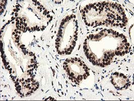 SULT1A1 / Sulfotransferase 1A1 Antibody - IHC of paraffin-embedded Carcinoma of Human prostate tissue using anti-SULT1A1 mouse monoclonal antibody.