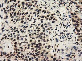 SULT1A1 / Sulfotransferase 1A1 Antibody - IHC of paraffin-embedded Carcinoma of Human bladder tissue using anti-SULT1A1 mouse monoclonal antibody.