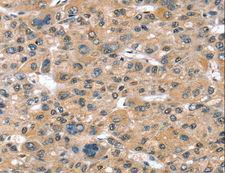 SULT1B1 / Sulfotransferase 1B1 Antibody - Immunohistochemistry of paraffin-embedded Human liver cancer using SULT1B1 Polyclonal Antibody at dilution of 1:30.