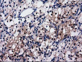 SULT1C2 / Sulfotransferase 1C2 Antibody - IHC of paraffin-embedded Carcinoma of Human kidney tissue using anti-SULT1C2 mouse monoclonal antibody. (Heat-induced epitope retrieval by 10mM citric buffer, pH6.0, 100C for 10min).