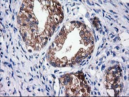 SULT1C2 / Sulfotransferase 1C2 Antibody - IHC of paraffin-embedded Adenocarcinoma of Human ovary tissue using anti-SULT1C2 mouse monoclonal antibody. (Heat-induced epitope retrieval by 10mM citric buffer, pH6.0, 100C for 10min).