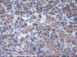 SULT1C2 / Sulfotransferase 1C2 Antibody - IHC of paraffin-embedded Carcinoma of Human thyroid tissue using anti-SULT1C2 mouse monoclonal antibody. (Heat-induced epitope retrieval by 10mM citric buffer, pH6.0, 100C for 10min).