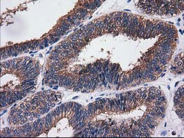 SULT1C2 / Sulfotransferase 1C2 Antibody - IHC of paraffin-embedded Adenocarcinoma of Human endometrium tissue using anti-SULT1C2 mouse monoclonal antibody. (Heat-induced epitope retrieval by 10mM citric buffer, pH6.0, 100C for 10min).
