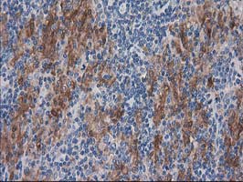 SULT1C2 / Sulfotransferase 1C2 Antibody - IHC of paraffin-embedded Human lymphoma tissue using anti-SULT1C2 mouse monoclonal antibody. (Heat-induced epitope retrieval by 10mM citric buffer, pH6.0, 100C for 10min).