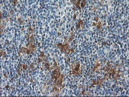SULT1C2 / Sulfotransferase 1C2 Antibody - IHC of paraffin-embedded Human lymphoma tissue using anti-SULT1C2 mouse monoclonal antibody. (Heat-induced epitope retrieval by 10mM citric buffer, pH6.0, 100C for 10min).