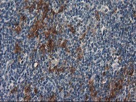 SULT1C2 / Sulfotransferase 1C2 Antibody - IHC of paraffin-embedded Human lymphoma tissue using anti-SULT1C2 mouse monoclonal antibody.