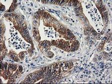 SULT1C2 / Sulfotransferase 1C2 Antibody - IHC of paraffin-embedded Adenocarcinoma of Human colon tissue using anti-SULT1C2 mouse monoclonal antibody.