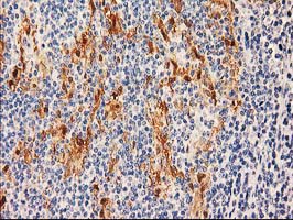 SULT1C2 / Sulfotransferase 1C2 Antibody - IHC of paraffin-embedded Human lymphoma tissue using anti-SULT1C2 mouse monoclonal antibody.