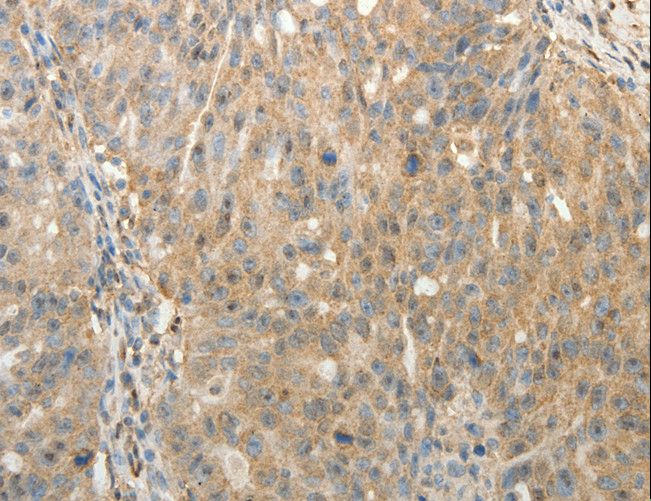 SULT1E1 / Sulfotransferase 1E1 Antibody - Immunohistochemistry of paraffin-embedded Human ovarian cancer using SULT1E1 Polyclonal Antibody at dilution of 1:30.