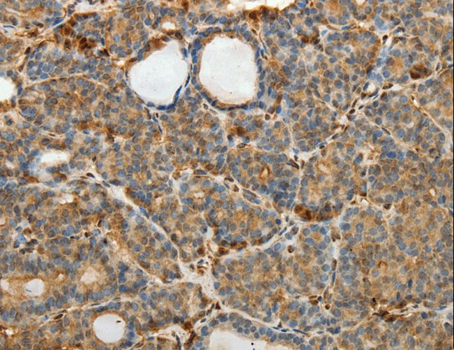 SULT1E1 / Sulfotransferase 1E1 Antibody - Immunohistochemistry of paraffin-embedded Human thyroid cancer using SULT1E1 Polyclonal Antibody at dilution of 1:30.