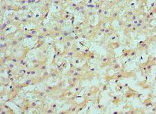 SULT2A1 / Sulfotransferase 2A1 Antibody - Immunohistochemistry of paraffin-embedded human liver cancer using antibody at 1:100 dilution.