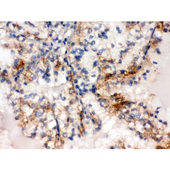 SULT2A1 / Sulfotransferase 2A1 Antibody - SULT2A1 antibody IHC-paraffin. IHC(P): Human Renal Cancer Tissue.