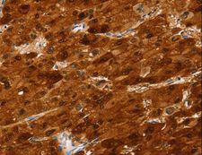 SULT2A1 / Sulfotransferase 2A1 Antibody - Immunohistochemistry of paraffin-embedded Human liver cancer using SULT2A1 Polyclonal Antibody at dilution of 1:25.