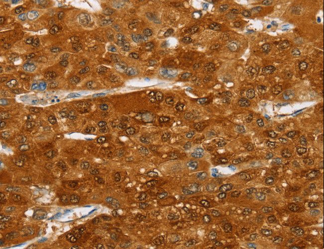 SULT2A1 / Sulfotransferase 2A1 Antibody - Immunohistochemistry of paraffin-embedded Human liver cancer using SULT2A1 Polyclonal Antibody at dilution of 1:20.