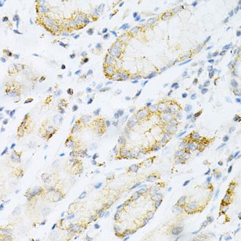 SULT2A1 / Sulfotransferase 2A1 Antibody - Immunohistochemistry of paraffin-embedded human gastric cancer using SULT2A1 Antibody at dilution of 1:200 (40x lens).