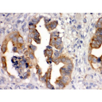 SULT2B1 / Sulfotransferase 2B1 Antibody - SULT2B1 antibody IHC-paraffin. IHC(P): Human Intestinal Cancer Tissue.
