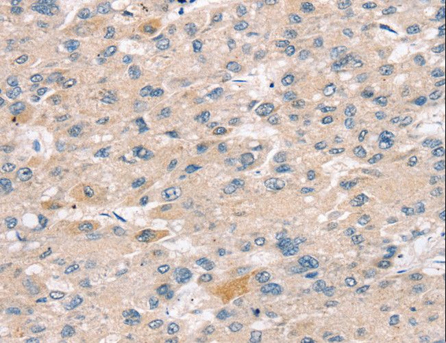 SULT2B1 / Sulfotransferase 2B1 Antibody - Immunohistochemistry of paraffin-embedded Human liver cancer using SULT2B1 Polyclonal Antibody at dilution of 1:25.