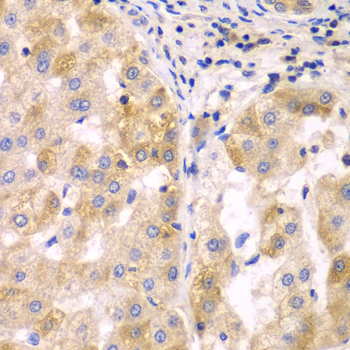 SULT2B1 / Sulfotransferase 2B1 Antibody - Immunohistochemistry of paraffin-embedded human liver cancer tissue.