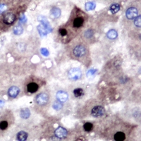 SULT2B1 / Sulfotransferase 2B1 Antibody - Immunohistochemical analysis of SULT2B1 staining in human liver cancer formalin fixed paraffin embedded tissue section. The section was pre-treated using heat mediated antigen retrieval with sodium citrate buffer (pH 6.0). The section was then incubated with the antibody at room temperature and detected using an HRP conjugated compact polymer system. DAB was used as the chromogen. The section was then counterstained with hematoxylin and mounted with DPX.