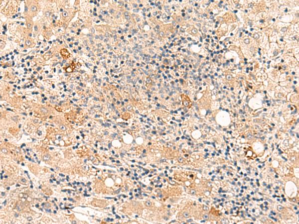 SULT4A1 / Sulfotransferase 4A1 Antibody - Immunohistochemistry of paraffin-embedded Human liver cancer tissue  using SULT4A1 Polyclonal Antibody at dilution of 1:50(×200)