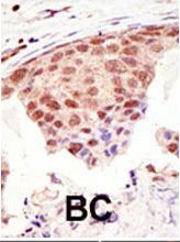 SUMO1 / SMT3 Antibody - Formalin-fixed and paraffin-embedded human cancer tissue reacted with the primary antibody, which was peroxidase-conjugated to the secondary antibody, followed by DAB staining. This data demonstrates the use of this antibody for immunohistochemistry; clinical relevance has not been evaluated. BC = breast carcinoma; HC = hepatocarcinoma.