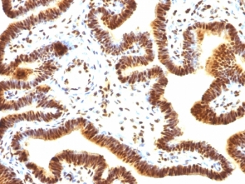 SUMO1 / SMT3 Antibody - Formalin-fixed, paraffin-embedded human ovarian carcinoma stained with SUMO-1 antibody (SUMO1/1188).  This image was taken for the unmodified form of this product. Other forms have not been tested.
