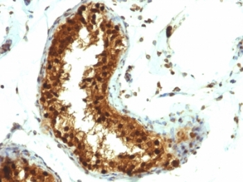 SUMO1 / SMT3 Antibody - Formalin-fixed, paraffin-embedded human testicular carcinoma stained with SUMO-1 antibody (SUMO1/1188).  This image was taken for the unmodified form of this product. Other forms have not been tested.