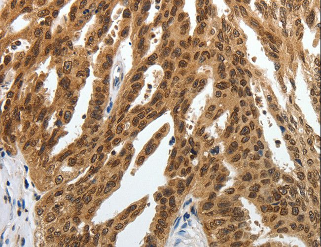 SUMO1 / SMT3 Antibody - Immunohistochemistry of paraffin-embedded Human lung cancer using SUMO1 Polyclonal Antibody at dilution of 1:30.