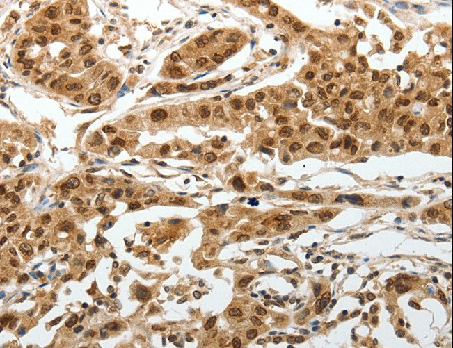 SUMO1 / SMT3 Antibody - Immunohistochemistry of paraffin-embedded Human lung cancer using SUMO1 Polyclonal Antibody at dilution of 1:30.