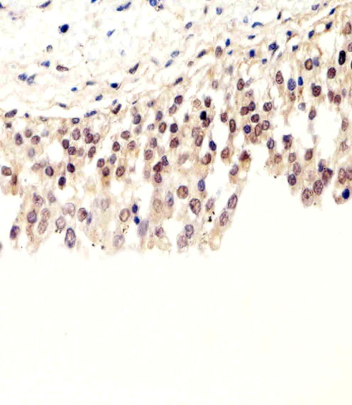 SUMO1 / SMT3 Antibody - Immunohistochemical of paraffin-embedded H.bladder section using Pan SUMO Antibody. Antibody was diluted at 1:100 dilution. A peroxidase-conjugated goat anti-rabbit IgG at 1:400 dilution was used as the secondary antibody, followed by DAB staining.