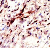 SUMO1 / SMT3 Antibody - Formalin-fixed and paraffin-embedded human cancer tissue reacted with the primary antibody, which was peroxidase-conjugated to the secondary antibody, followed by AEC staining. This data demonstrates the use of this antibody for immunohistochemistry; clinical relevance has not been evaluated. BC = breast carcinoma; HC = hepatocarcinoma.