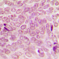 SUMO1 / SMT3 Antibody - Immunohistochemical analysis of SUMO1 staining in human breast cancer formalin fixed paraffin embedded tissue section. The section was pre-treated using heat mediated antigen retrieval with sodium citrate buffer (pH 6.0). The section was then incubated with the antibody at room temperature and detected using an HRP conjugated compact polymer system. DAB was used as the chromogen. The section was then counterstained with hematoxylin and mounted with DPX.