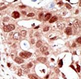SUMO2 Antibody - Formalin-fixed and paraffin-embedded human cancer tissue reacted with the primary antibody, which was peroxidase-conjugated to the secondary antibody, followed by AEC staining. This data demonstrates the use of this antibody for immunohistochemistry; clinical relevance has not been evaluated. BC = breast carcinoma; HC = hepatocarcinoma.