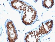 SUMO2 Antibody - Formalin-fixed, paraffin-embedded human testicular carcinoma stained with SUMO-2/3 antibody (SPM572).  This image was taken for the unmodified form of this product. Other forms have not been tested.