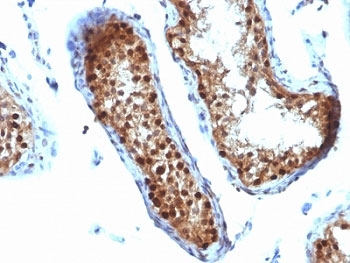 SUMO2 Antibody - Formalin-fixed, paraffin-embedded human testicular carcinoma stained with SUMO-2 antibody.  This image was taken for the unmodified form of this product. Other forms have not been tested.