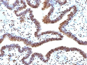 SUMO2 Antibody - Formalin-fixed, paraffin-embedded human ovarian carcinoma stained with SUMO-2 antibody.  This image was taken for the unmodified form of this product. Other forms have not been tested.