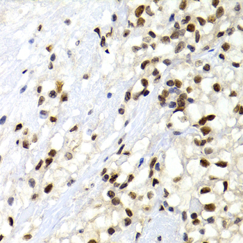 SUMO2 Antibody - Immunohistochemistry of paraffin-embedded human kidney cancer tissue.