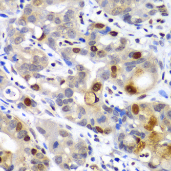 SUMO2 Antibody - Immunohistochemistry of paraffin-embedded human gastric cancer tissue.