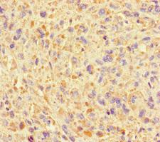 SUMO2 Antibody - Immunohistochemistry of paraffin-embedded human melanoma cancer at dilution of 1:100