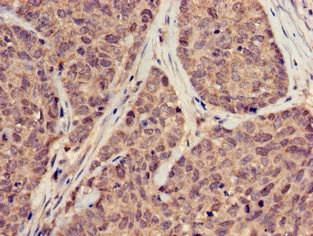 SUMO3 Antibody - Immunohistochemistry of paraffin-embedded human ovarian cancer at dilution of 1:100