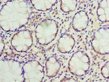 SUMO4 Antibody - Immunohistochemistry of paraffin-embedded human colon cancer using antibody at 1:100 dilution.