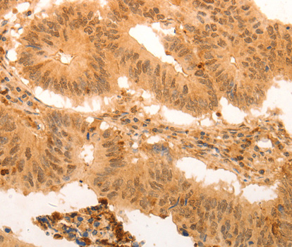 SUMO4 Antibody - Immunohistochemistry of paraffin-embedded Human colon cancer tissue.