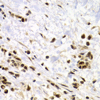 SUMO4 Antibody - Immunohistochemistry of paraffin-embedded human kidney cancer tissue.