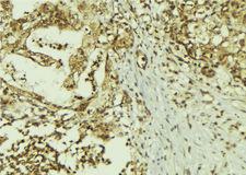 SUN5 / SPAG4L Antibody - 1:100 staining human breast carcinoma tissue by IHC-P. The sample was formaldehyde fixed and a heat mediated antigen retrieval step in citrate buffer was performed. The sample was then blocked and incubated with the antibody for 1.5 hours at 22°C. An HRP conjugated goat anti-rabbit antibody was used as the secondary.